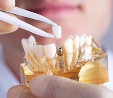 Dental Implants
